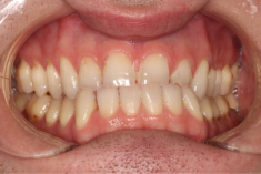 VickongDental veneers