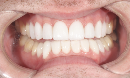 veneer treatment